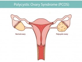 关于青春期多囊卵巢综合征，这些事情您可能还不知道？